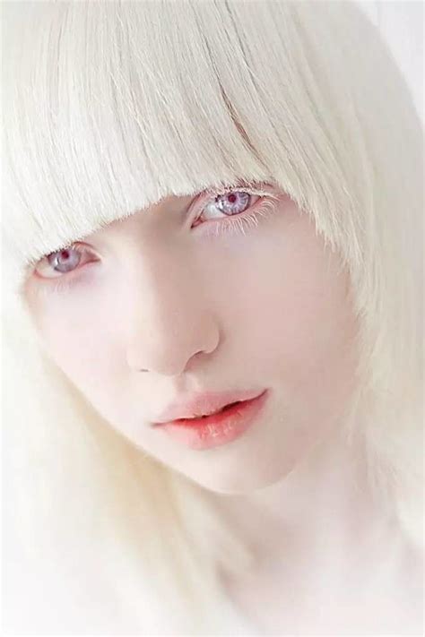 Pin By Manu El On Pen And Paper Rl Albino Model Albinism Albino Girl