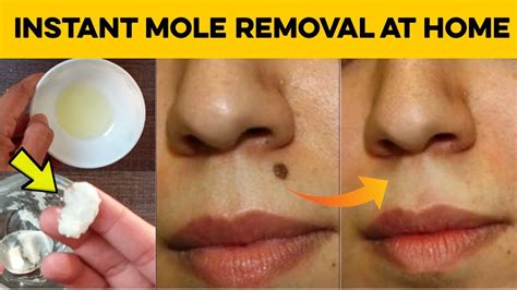 How To Get Rid Of Moles On Your Face Quickly Ninepointfivedesigns