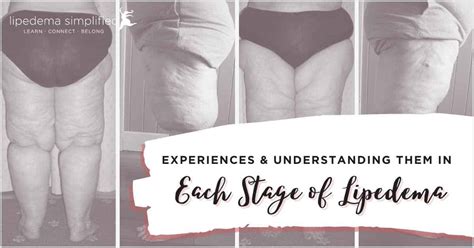 Stages Of Lipedema Understanding The Experiences Of Patients