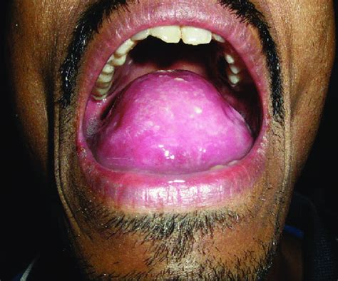 Swelling Involving Anterior Two Thirds Of The Tongue And The Floor Of