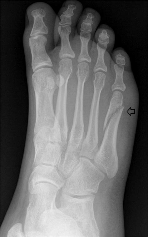 Diagnosis And Management Of Common Foot Fractures Hot Sex Picture