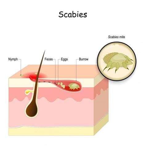 How To Tell If Scabies Is Going Away Top 5 Natural Remedies