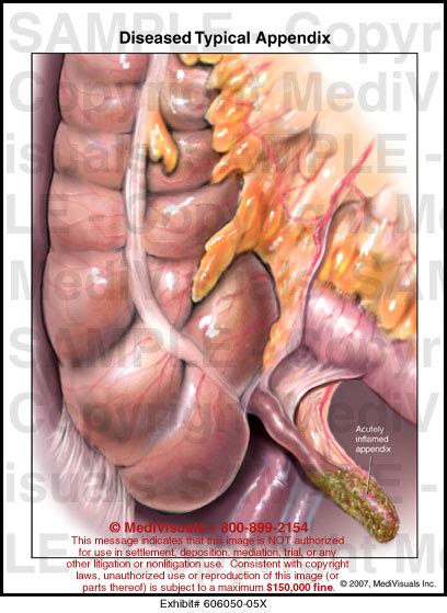 Diseased Typical Appendix Medical Illustrationmedivisuals