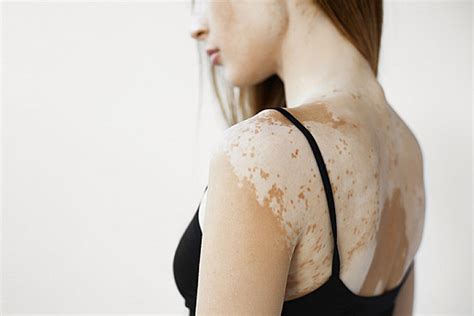 Vitiligo More Than Skin Deep Harvard Health