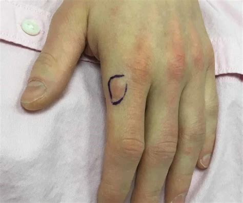Cureus Firm Cutaneous Nodule On The Dorsal Hand A Case Report On