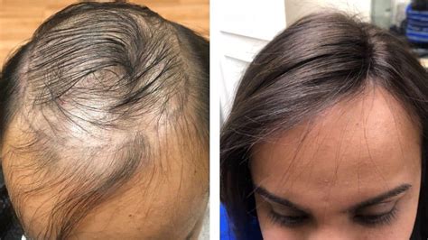 Womens Non Surgical Hair Replacement Paramus Nj Guci Image Inc