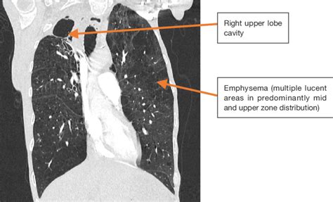 Coronal Image From A Ct Chest Demonstrating Extensive Emphysematous