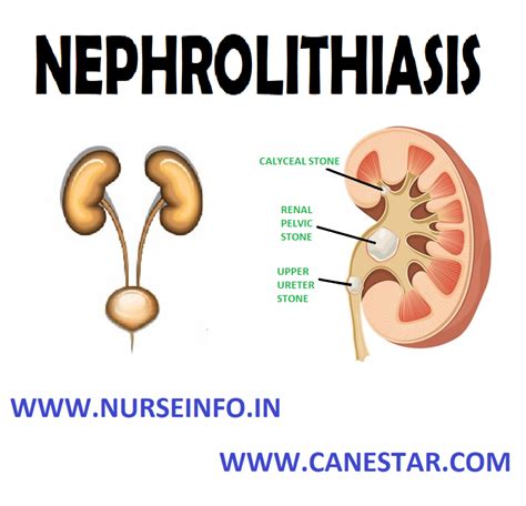 Nephrolithiasis Nurse Info