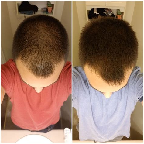 Your hair grows half an inch per month and six inches per year—ideally. Dec. 22nd vs. Jan 24th. Showing hair growth rate. : tressless