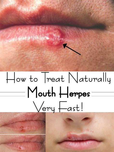 What Does Oral Herpes Look Like When It First Starts What Does