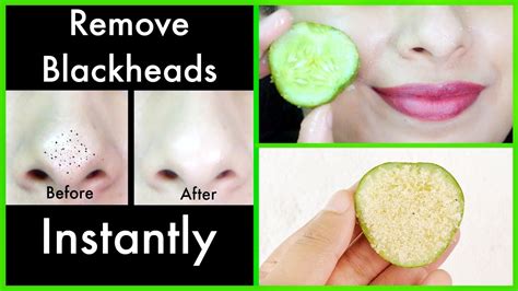 Blackheads On Face Removal Home Remedy