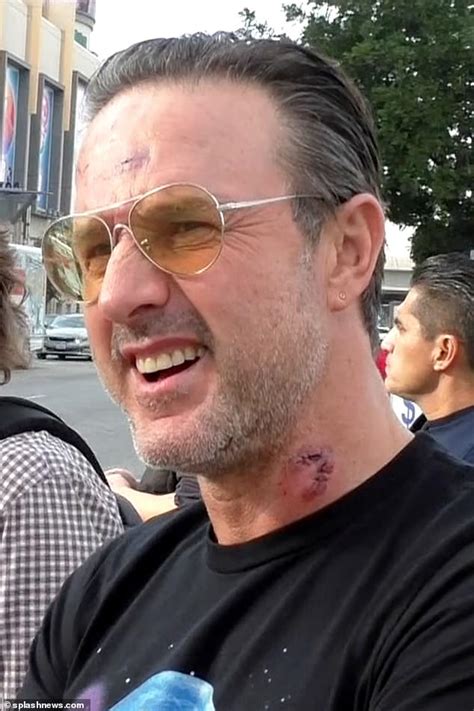 David Arquette Sports Gashes And Bruises After Being Brutalized During