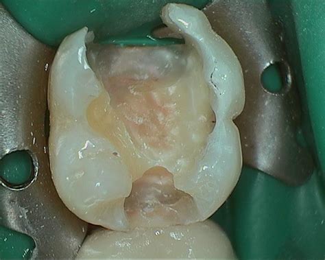 Sweet Tooth Distal Decay On 2nd Molars