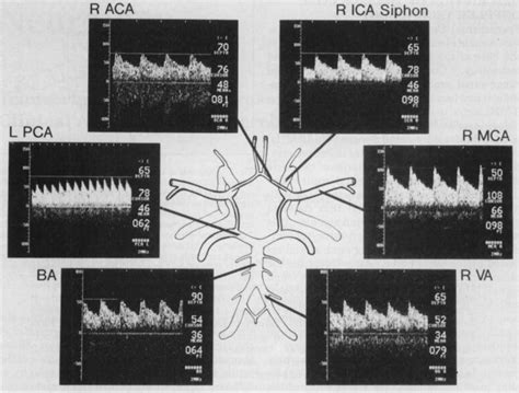 Transcranial Doppler Ultrasonography Clinical Applications In