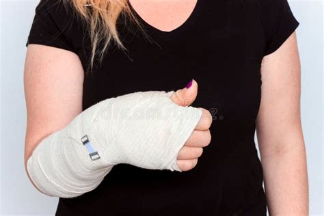 Young Female With Broken Hand In Cast Stock Image Image Of Gypsum