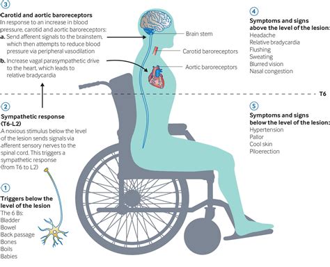 Autonomic Dysreflexia In Spinal Cord Injury The BMJ