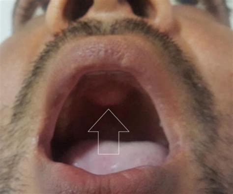 Oral Cancer Bump On Roof Of Mouth Sinus Infection Latest Rooftop Ideas