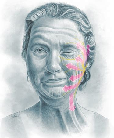 Hemifacial Spasm Microsurgical Treatment Shown In 3D