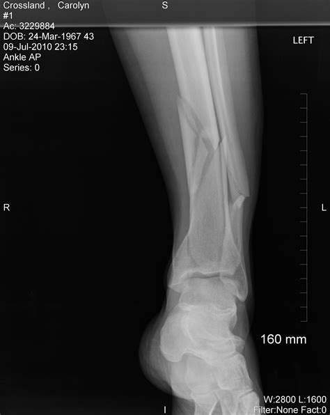 Picture Of Spiral Fracture Of Fibula Spiral Fracture Healing Time