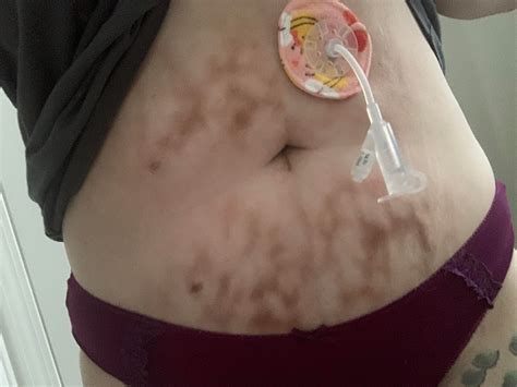 Tw Bare Stomach And Feeding Tube Does Anyone Else Get Burns Like