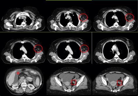 Whole‐body Computed Tomography Ct Scan Showed Lymphadenopathies Of