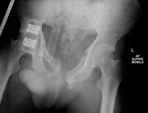 Open Book Pelvis Fracture With Traumatic Urethral Injury Radiology