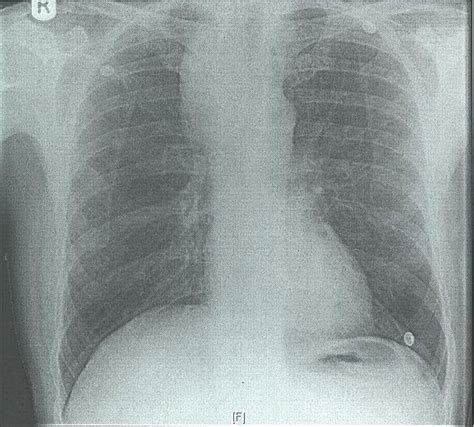 An Unusual Cause Of A Mediastinal Mass Bmj Case Reports