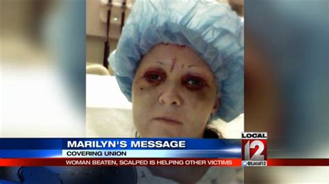 Woman Beaten And Scalped In Domestic Violence Attack Helping Other Victims