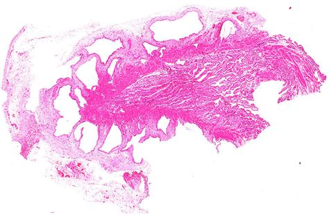 The Corresponding Histology Shows Cystically Dilated Glands