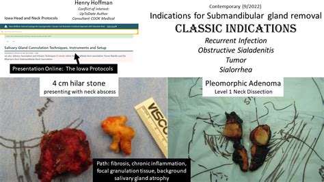 Submandibular Gland Resection Iowa Head And Neck Protocols