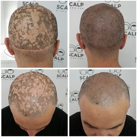 Scalp Micro Usa Hides An Alopecia Patients Hair Loss With Unique Scalp