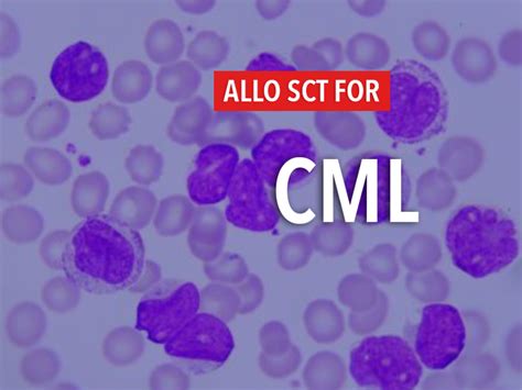 Allogeneic Stem Cell Transplantation For Chronic Myeloid Leukemia