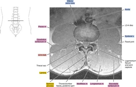 Mri Of The Lumbar Spine Radiology Key
