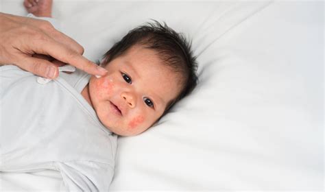 5 Tips To Help With Eczema In Babies Brighter World