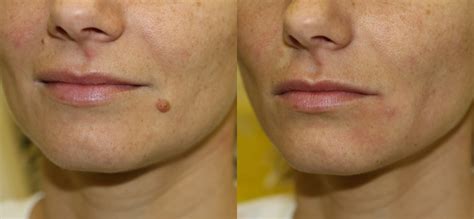 Mole Removal Prices Costs Skin Surgery Laser Clinic