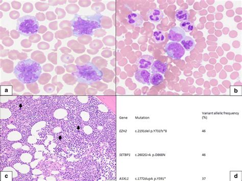 Therapy Related Cmml A Peripheral Blood Smear Shows Relative And