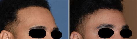 Plastic Surgery Case Study Male Total Forehead Reshaping Explore