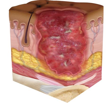 Pressure Injury 101 Stage 3 Pressure Ulcers