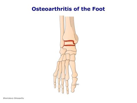 Osteoarthritis Of The Ankle And Foot Fotp06 Bloomsbury Health Centre