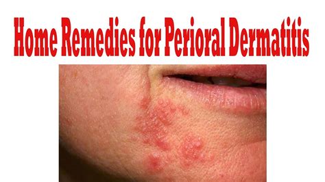 How To Cure Perioral Dermatitis How To Get Rid Of Perioral