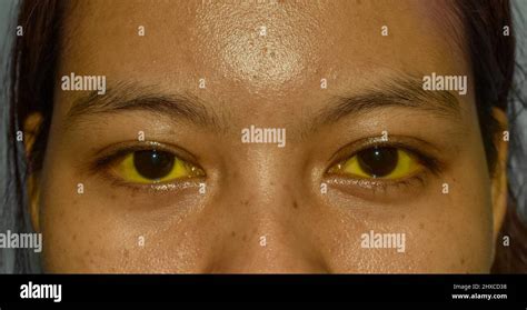 Deep Jaundice In Asian Female Patient Yellowish Discoloration Of Skin