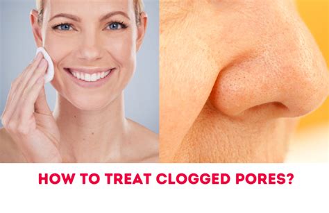 How To Treat Clogged Pores On Face At Home Trabeauli