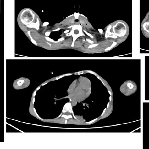 Figure1chest And Skeletal Muscle Computed Tomography Ct Chest Ct