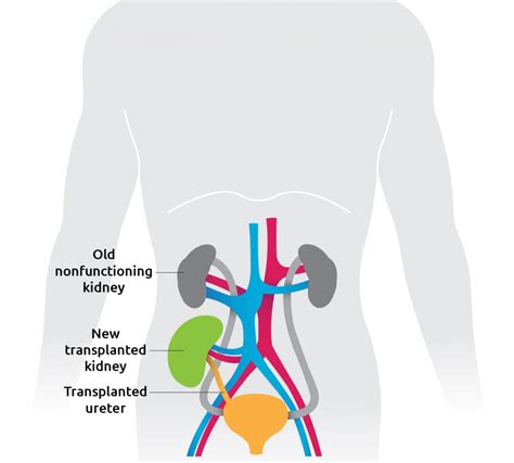 Torso Transplanted Kidneys2x Transplant Living