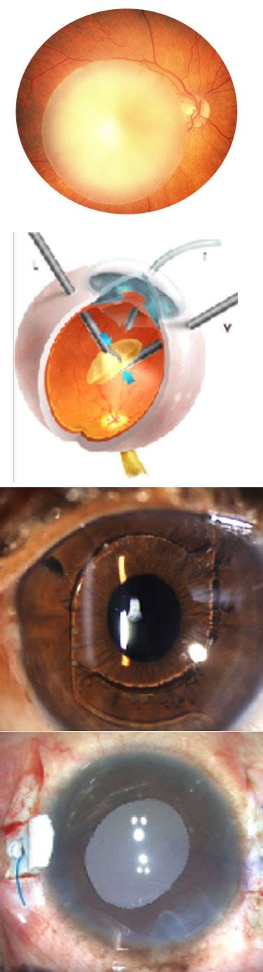 Posterior Dislocation Of Lens Synergy Eye Care