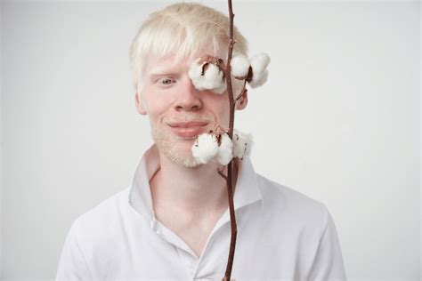 Czym Jest Albinizm Poznaj Przyczyny Tej Choroby Zdrowe Zdrowie Hot