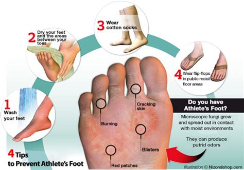 Tinea Pedis Athletes Foot Best Ways To Treat It