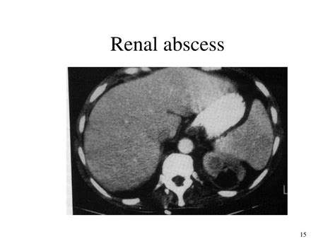 Ppt Urnary Tract Infectin Acute Pyelonephritis Renal And Perirenal