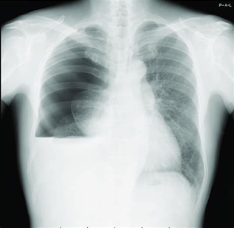 Chest Radiography Shows Right Sided Severe Pneumothorax With Pleural