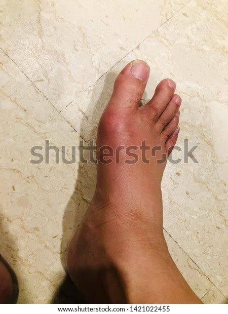 Gout Symptoms Swollen Joint Near Toe Stock Photo Edit Now 1421022455